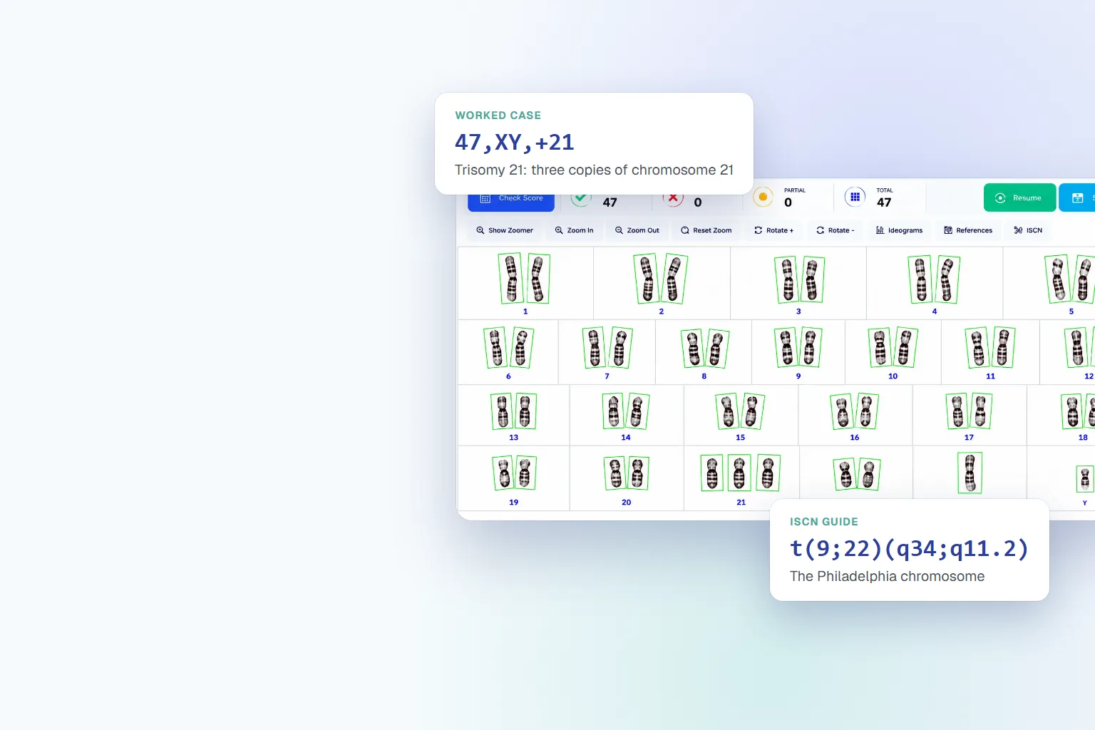 A completed karyogram with worked-case cards for trisomy 21 and the Philadelphia chromosome